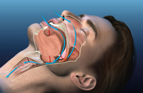 What causes snoring